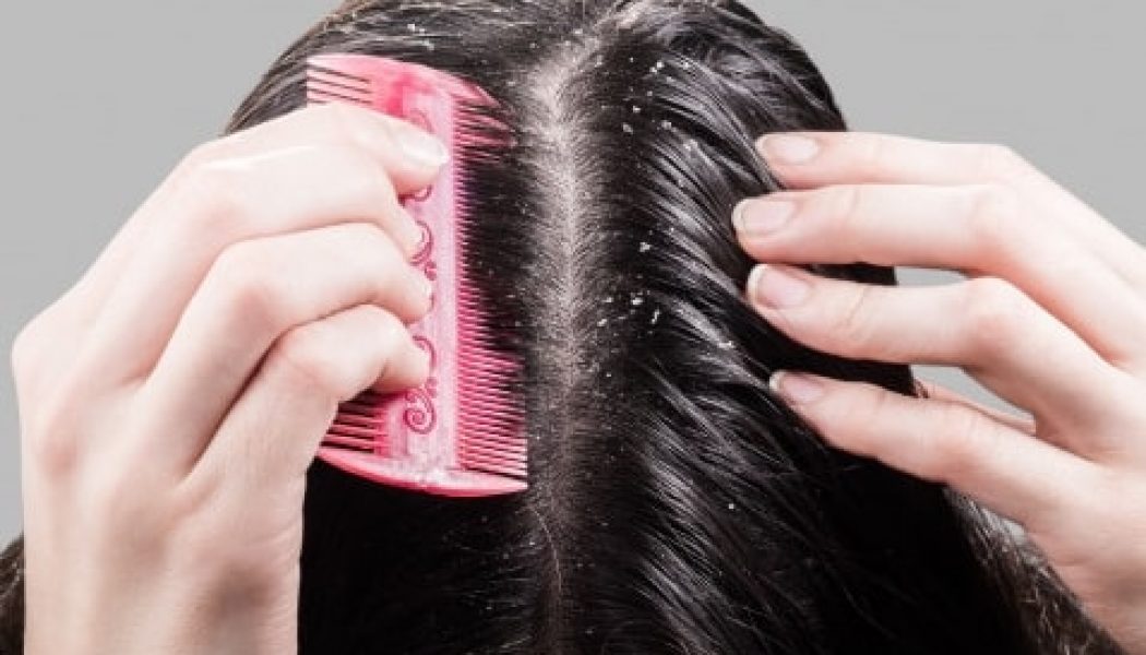 Get Rid Of Dandruff Naturally With These Remedies