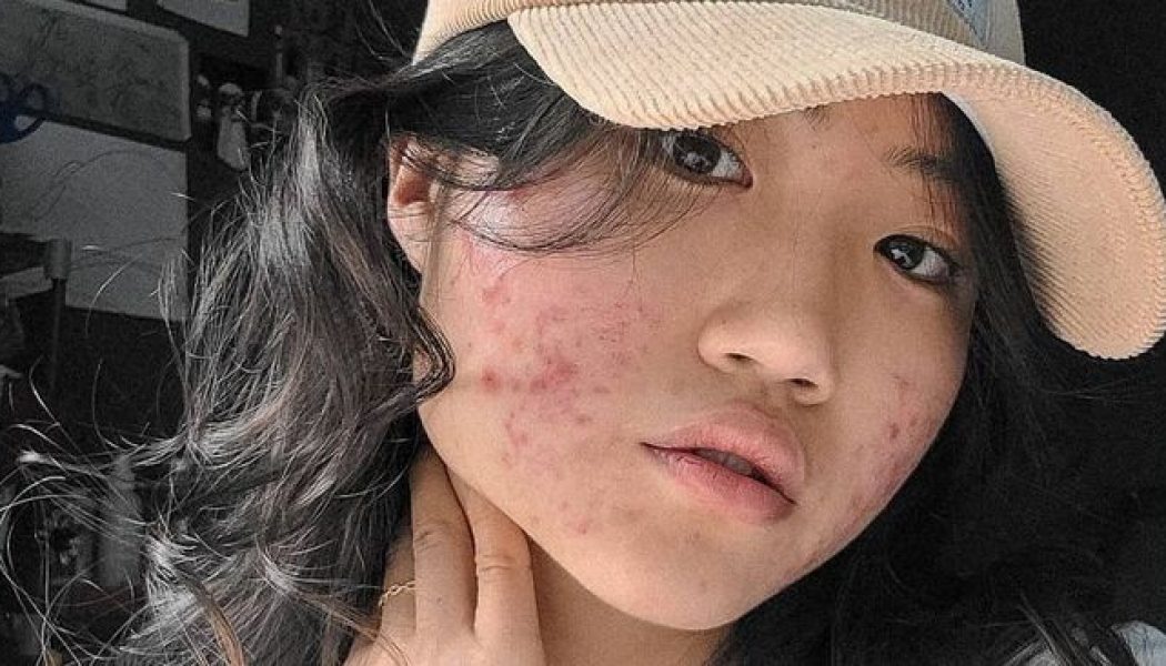 This Is the Best Skincare Routine For Acne, According to a Dermatologist