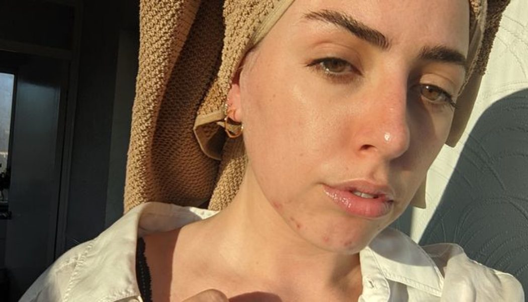 I Developed Acne in My Late 20s—This Is Everything My Dermatologist Taught Me