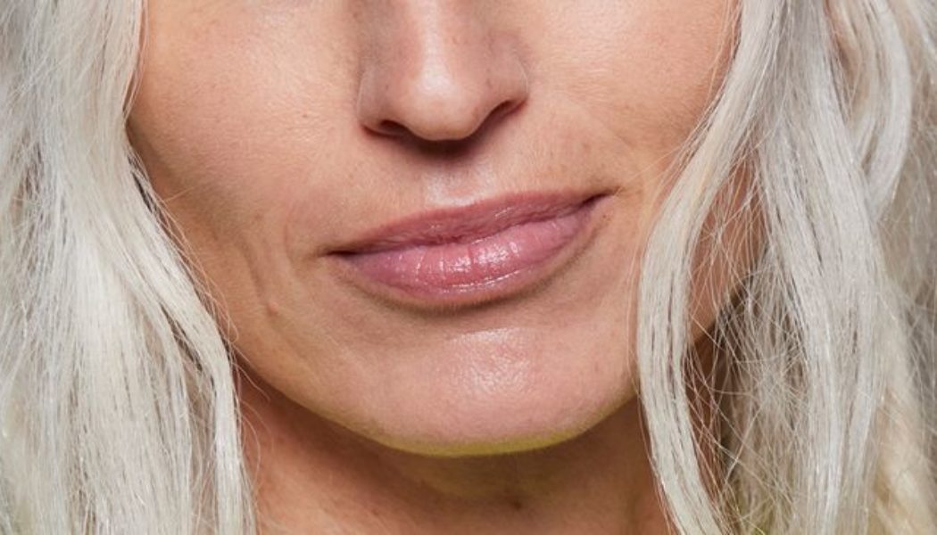 Dermatologists Say These 6 Treatments Are Best for Lip Lines