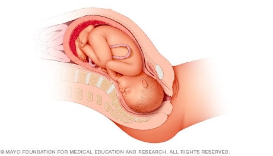 Fetal presentation before birth