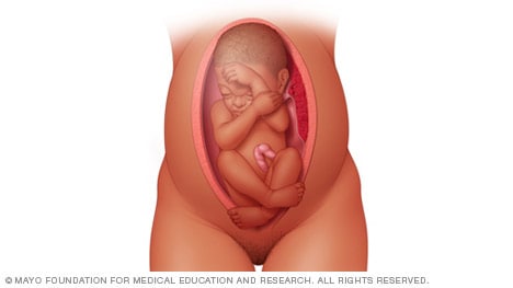 Illustration of a complete breech presentation