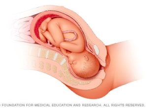 Fetal presentation before birth