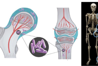 Healthy Living: Musculoskeletal infection