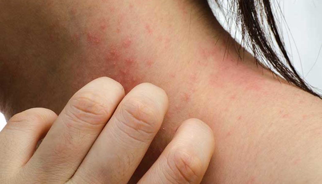 How Lifestyle Changes and Self-Care Can Improve Your Eczema