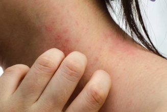 How Lifestyle Changes and Self-Care Can Improve Your Eczema